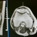 Ruptura splinei: cauze, diagnostic, tratament
